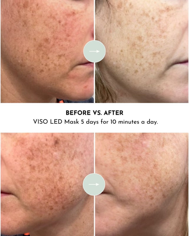 Lumara VISO 660nm Red Light LED Face Mask